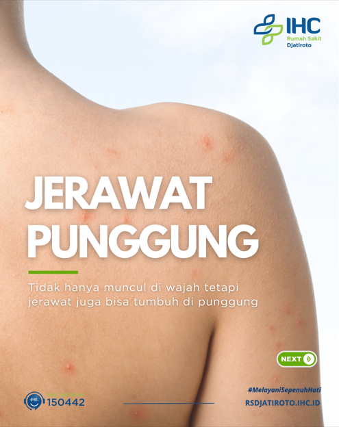Jerawat Punggung: Tidak Hanya di Wajah, Jerawat Juga Bisa Muncul di Punggung